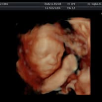 Fetal diagnostic procedure